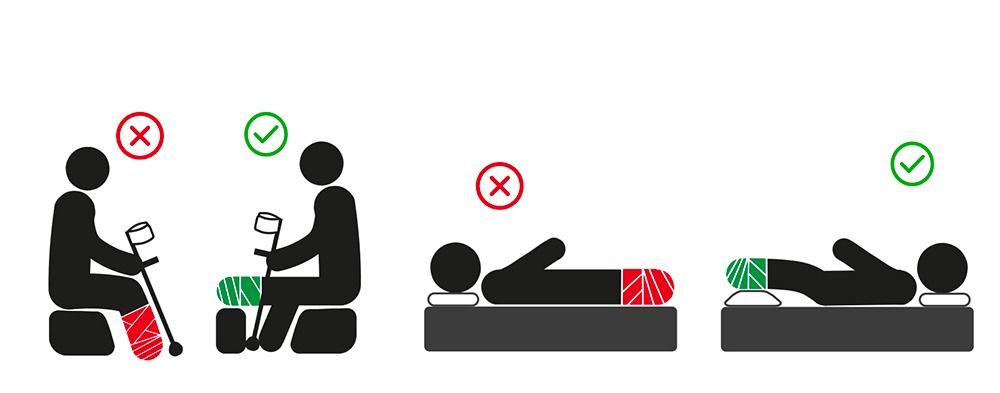 Surélever sa jambe avec un plâtre